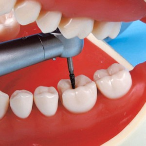 Treatment forms of Conservative Dentistry