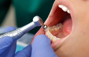 Dental Prophylaxis