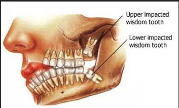 Impaction Tooth Extraction