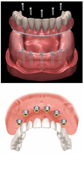 Procedure for Implant Prosthesis